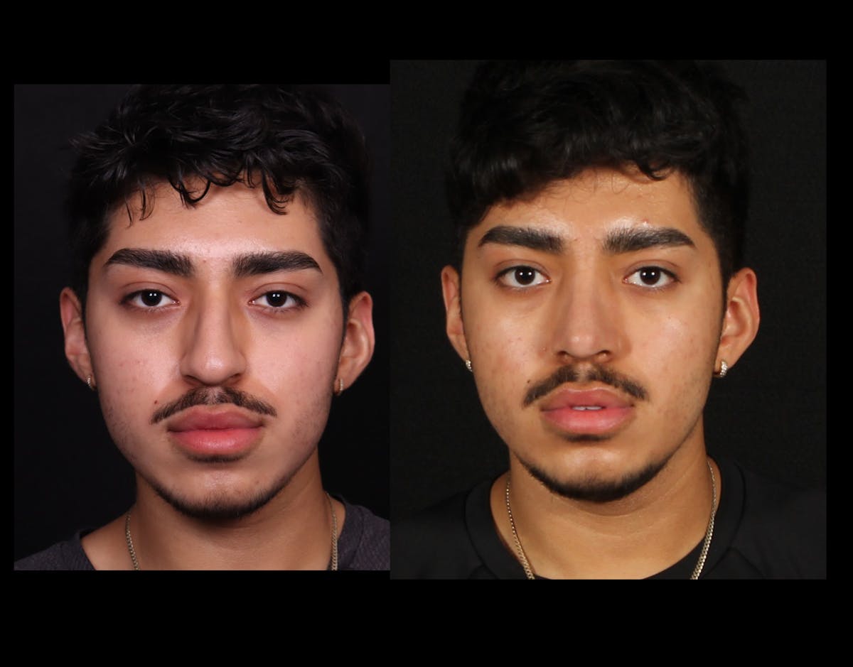 Rhinoplasty Male Before & After Gallery - Patient 584341 - Image 3