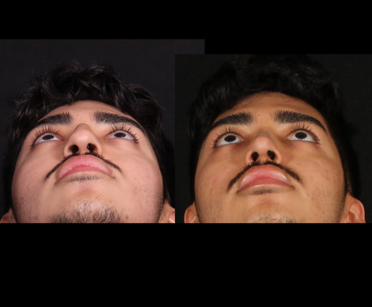 Rhinoplasty Male Before & After Gallery - Patient 584341 - Image 4