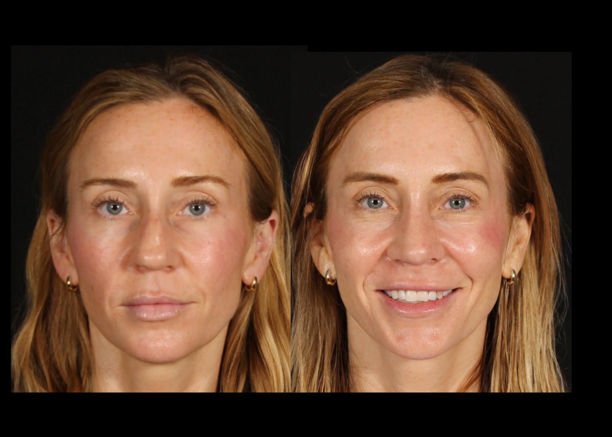 Rhinoplasty Female Before & After Gallery - Patient 172002 - Image 3