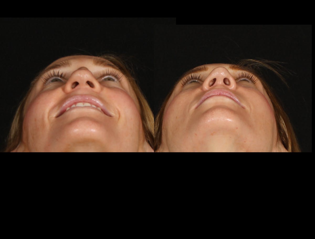 Rhinoplasty Female Before & After Gallery - Patient 172002 - Image 5