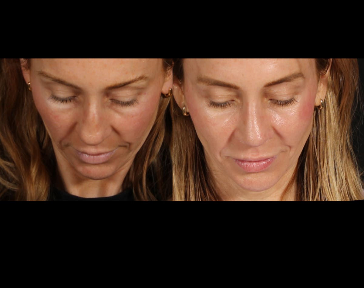 Rhinoplasty Female Before & After Gallery - Patient 172002 - Image 4