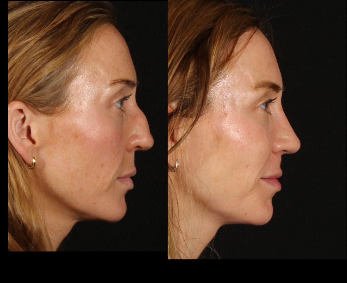 Rhinoplasty Female Before & After Gallery - Patient 172002 - Image 1