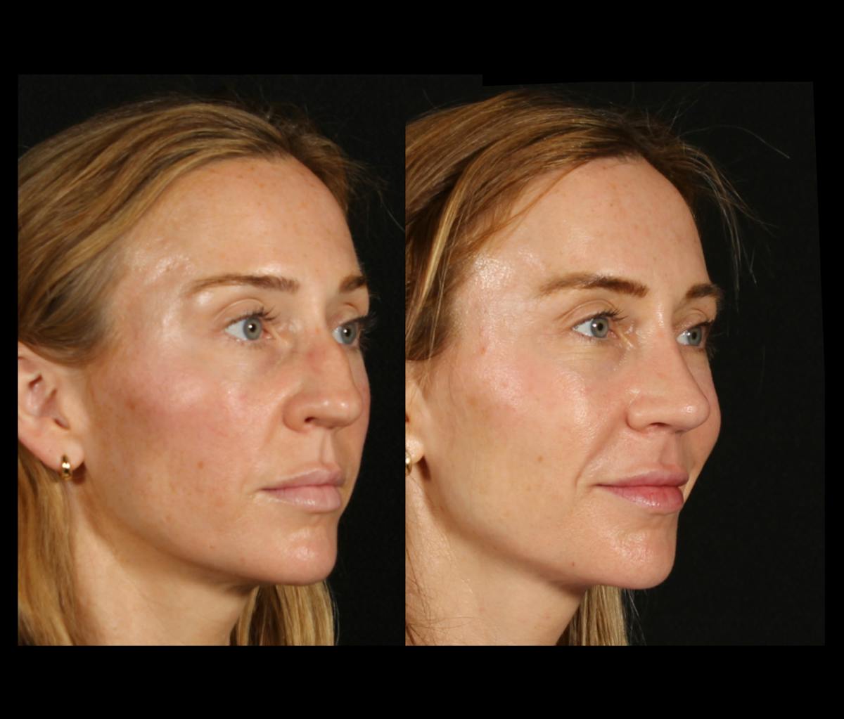 Rhinoplasty Female Before & After Gallery - Patient 172002 - Image 2