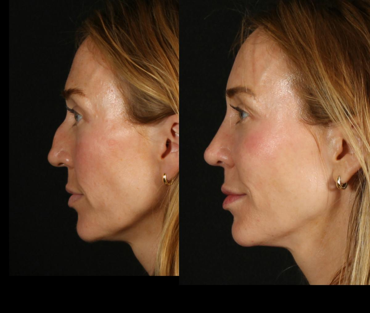 Rhinoplasty Female Before & After Gallery - Patient 172002 - Image 6