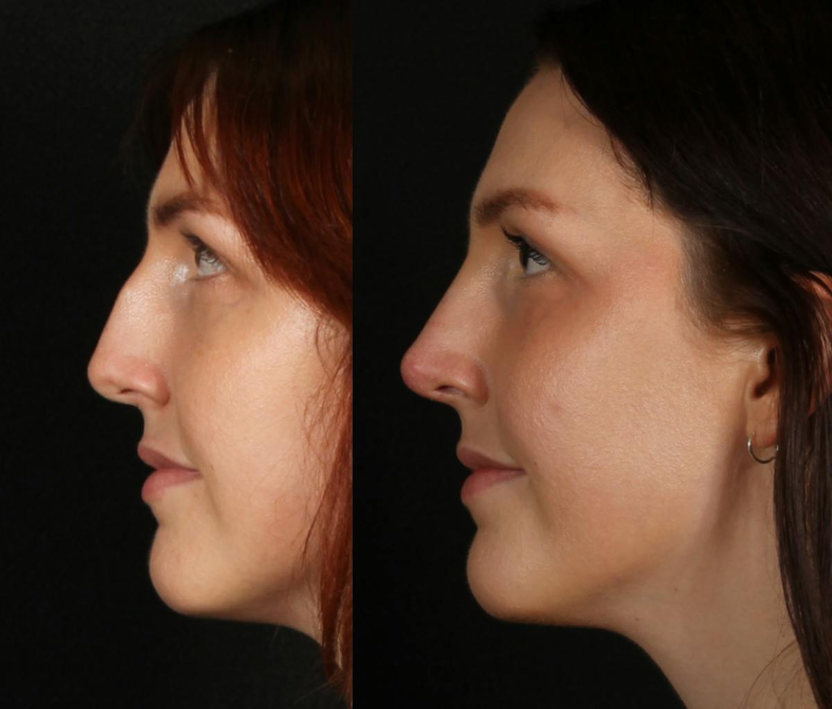 Rhinoplasty Female Before & After Gallery - Patient 317701 - Image 2