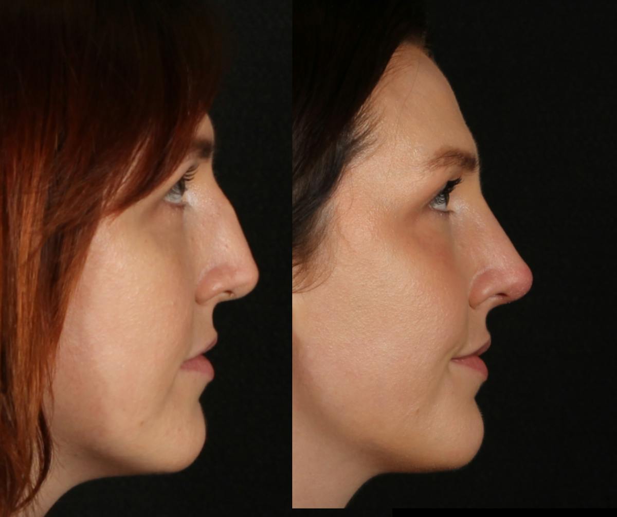 Rhinoplasty Female Before & After Gallery - Patient 317701 - Image 1
