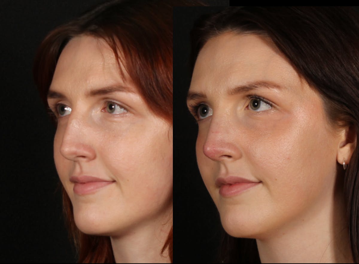 Rhinoplasty Female Before & After Gallery - Patient 317701 - Image 3