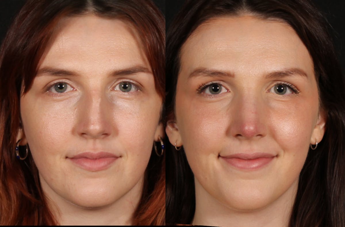 Rhinoplasty Female Before & After Gallery - Patient 317701 - Image 4