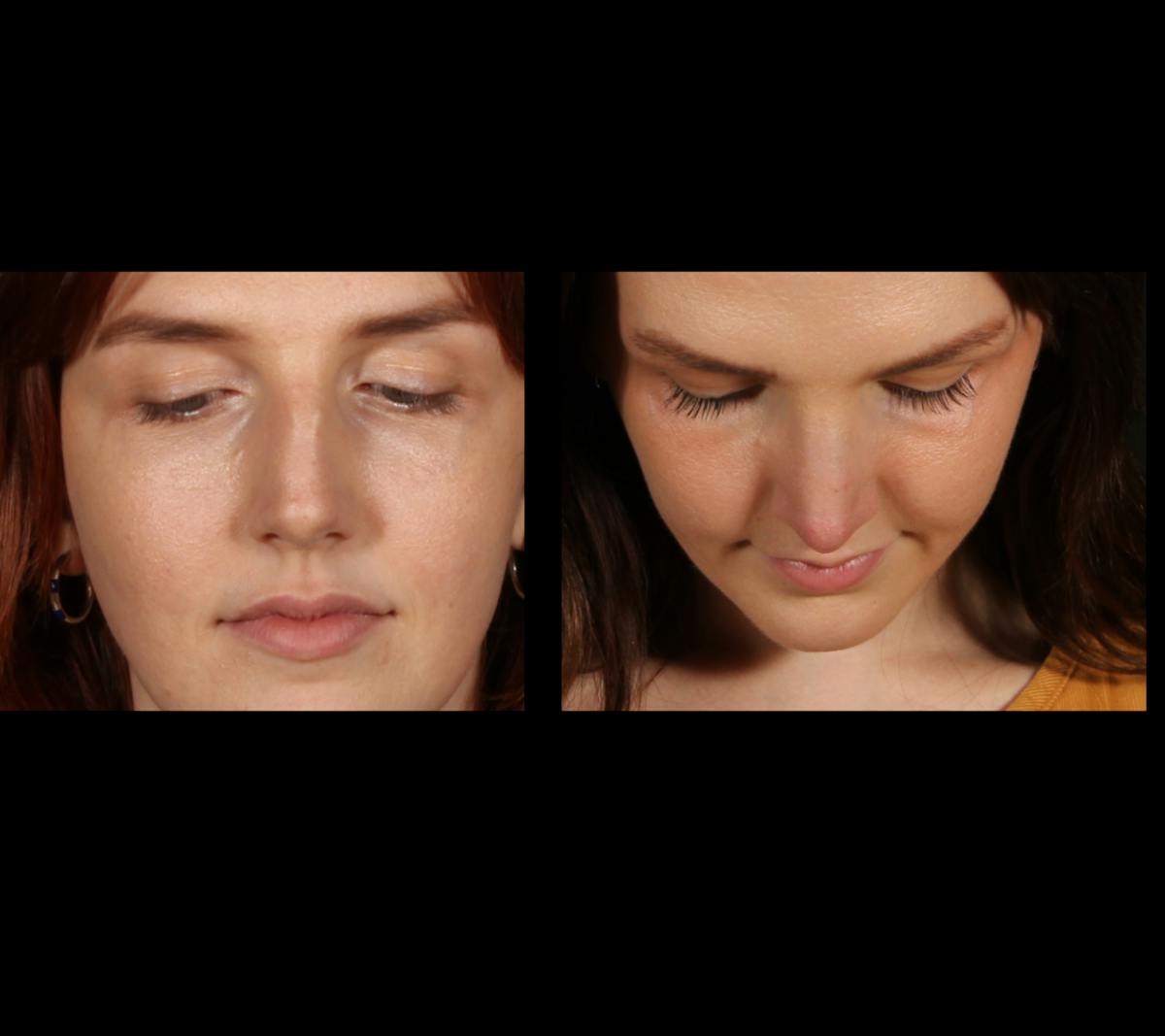 Rhinoplasty Female Before & After Gallery - Patient 317701 - Image 5