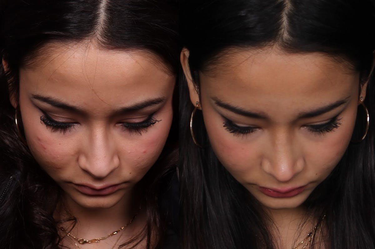 Rhinoplasty Female Before & After Gallery - Patient 210792 - Image 4
