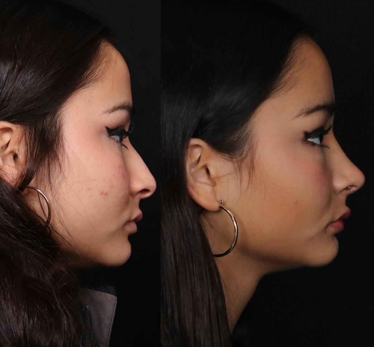 Rhinoplasty Female Before & After Gallery - Patient 210792 - Image 1