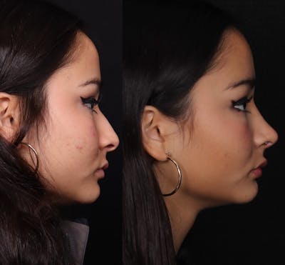 Rhinoplasty Female Before & After Gallery - Patient 210792 - Image 1