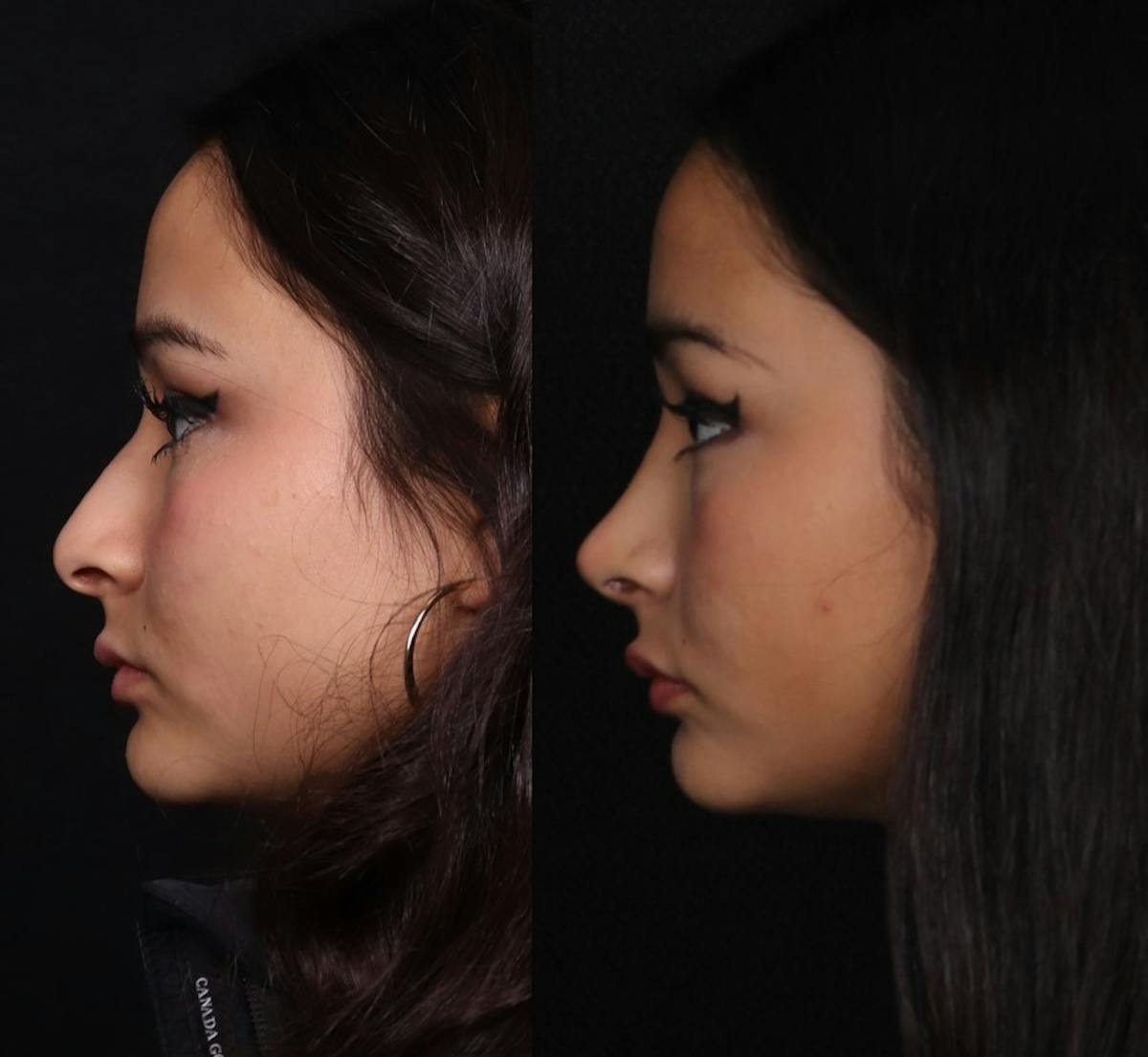 Rhinoplasty Female Before & After Gallery - Patient 210792 - Image 7