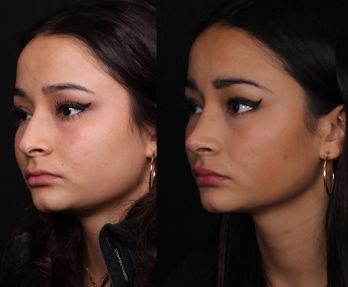 Rhinoplasty Female Before & After Gallery - Patient 210792 - Image 6