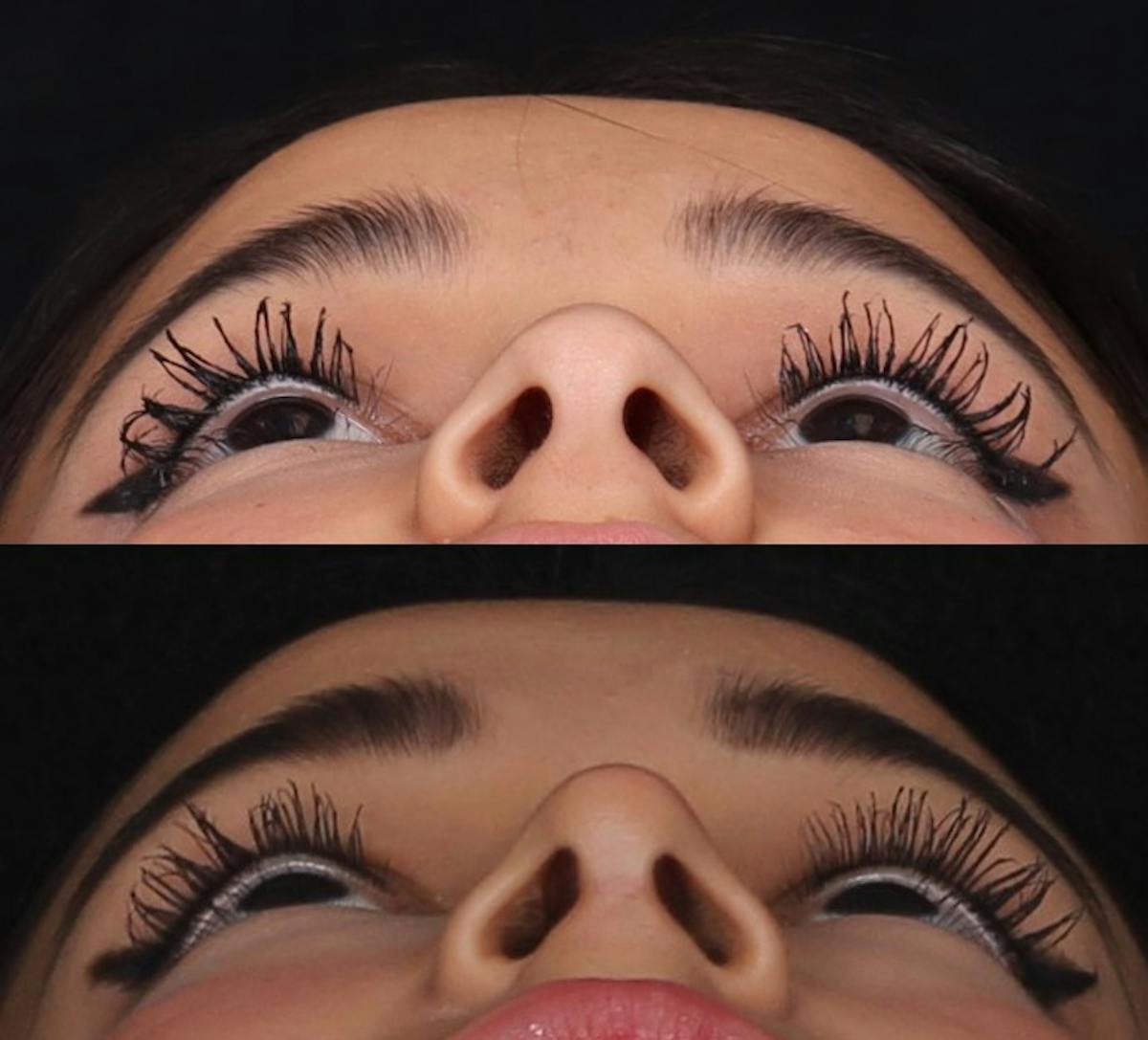 Rhinoplasty Female Before & After Gallery - Patient 210792 - Image 5