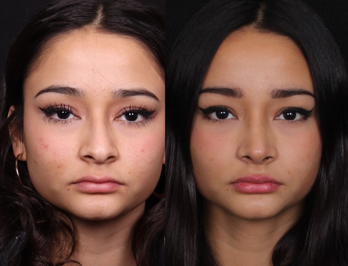 Rhinoplasty Female Before & After Gallery - Patient 210792 - Image 3