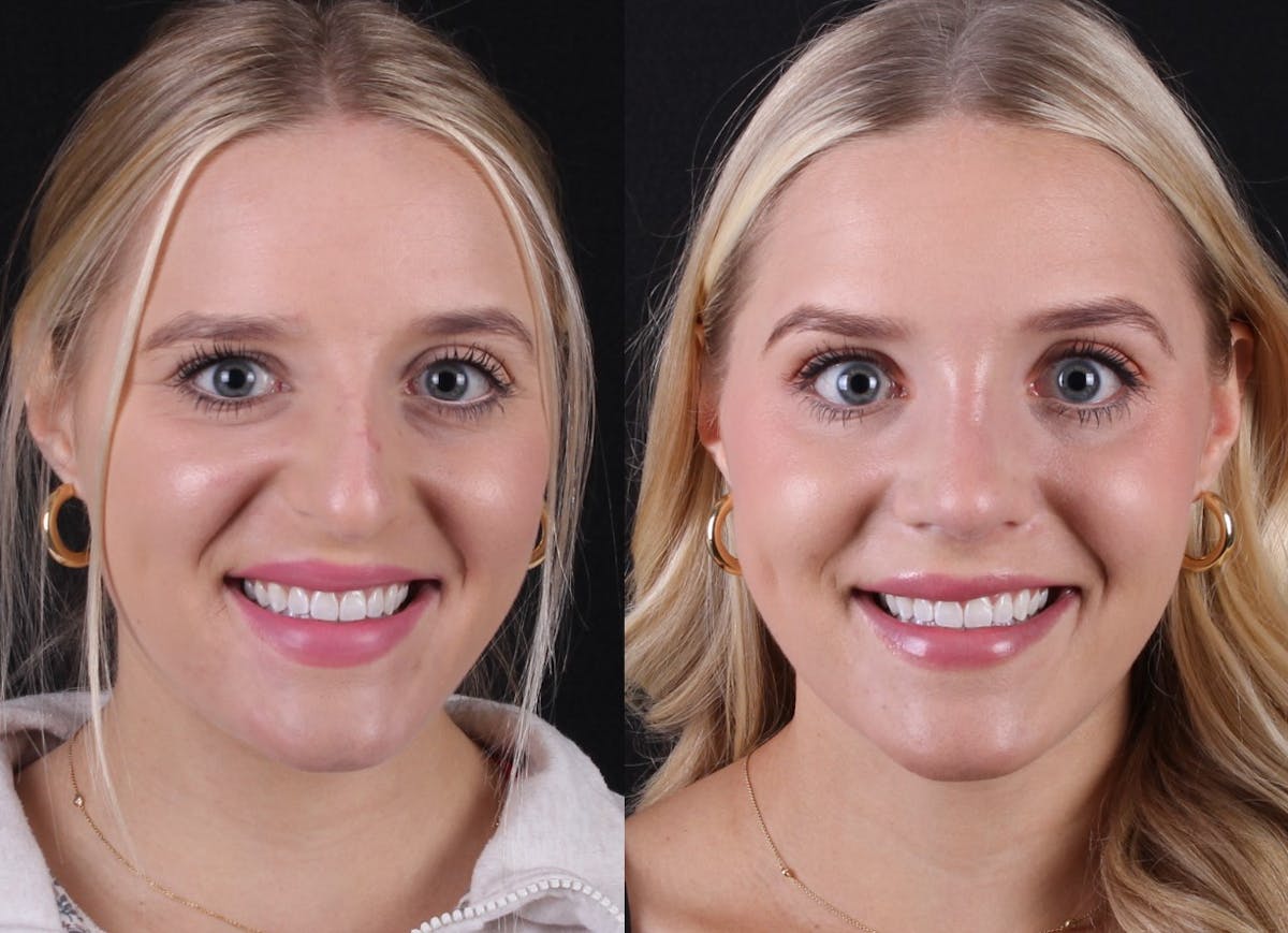 Rhinoplasty Female Before & After Gallery - Patient 415225 - Image 3