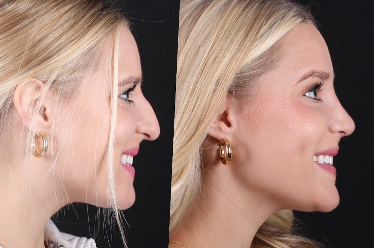 Rhinoplasty Female Before & After Gallery - Patient 415225 - Image 1