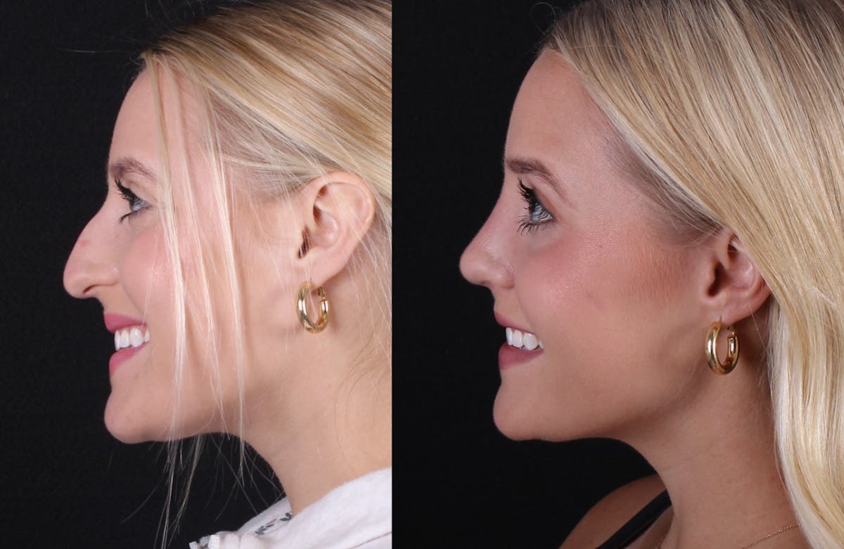 Rhinoplasty Female Before & After Gallery - Patient 415225 - Image 5