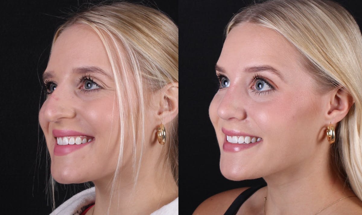 Rhinoplasty Female Before & After Gallery - Patient 415225 - Image 4