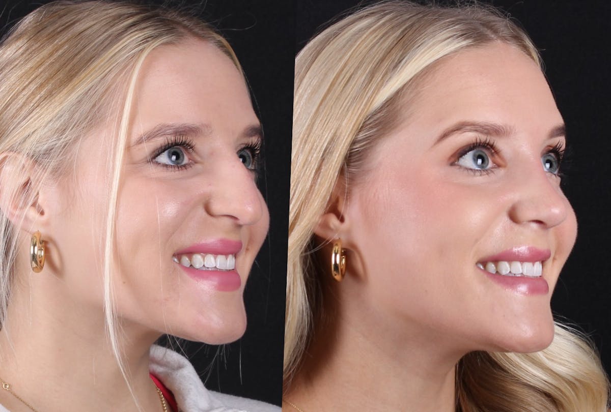 Rhinoplasty Female Before & After Gallery - Patient 415225 - Image 2