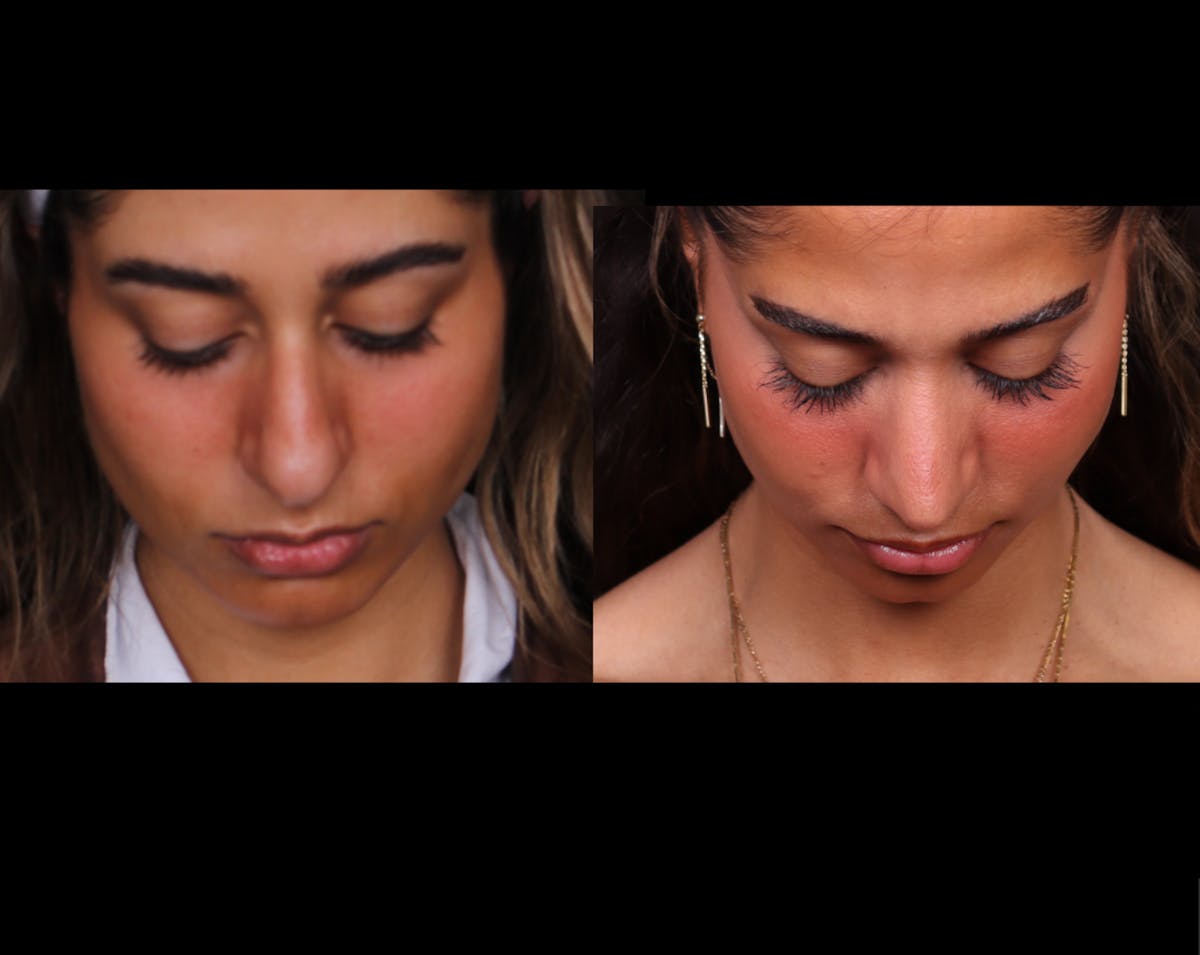 Rhinoplasty Female Before & After Gallery - Patient 329804 - Image 4