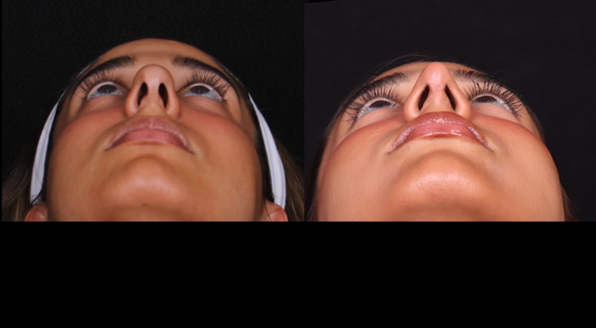Rhinoplasty Female Before & After Gallery - Patient 329804 - Image 3