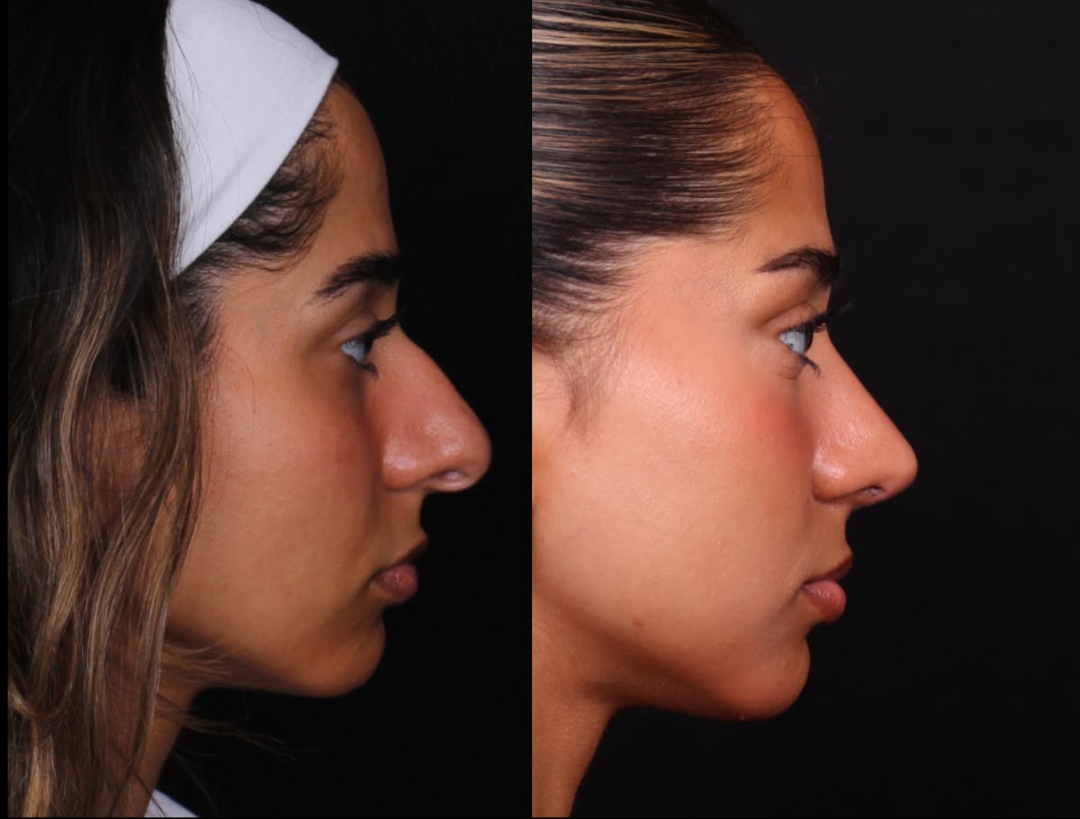 Rhinoplasty Female Before & After Gallery - Patient 329804 - Image 1
