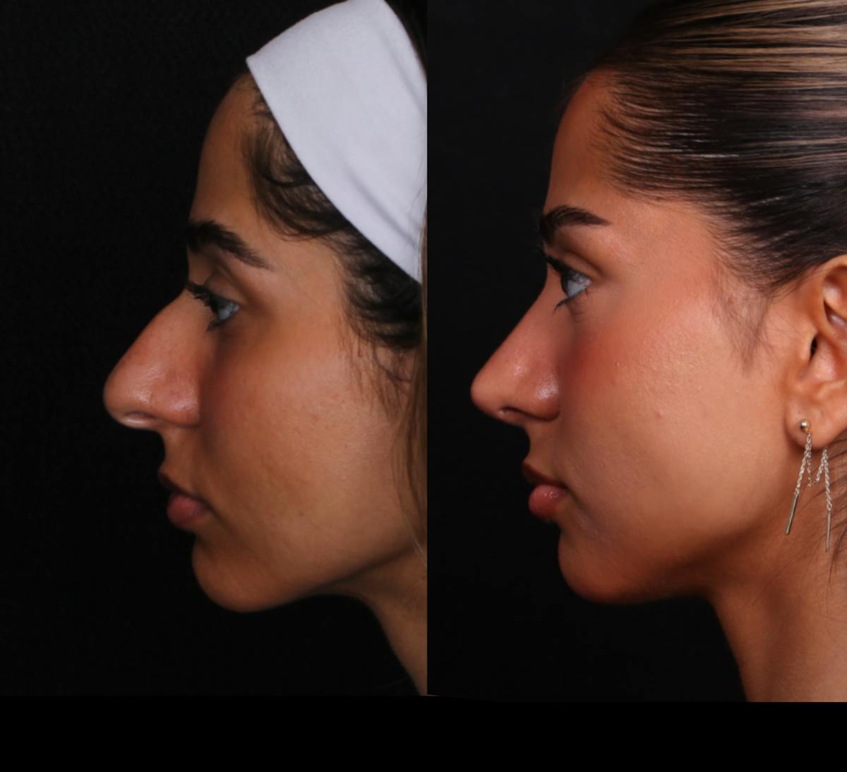 Rhinoplasty Female Before & After Gallery - Patient 329804 - Image 6