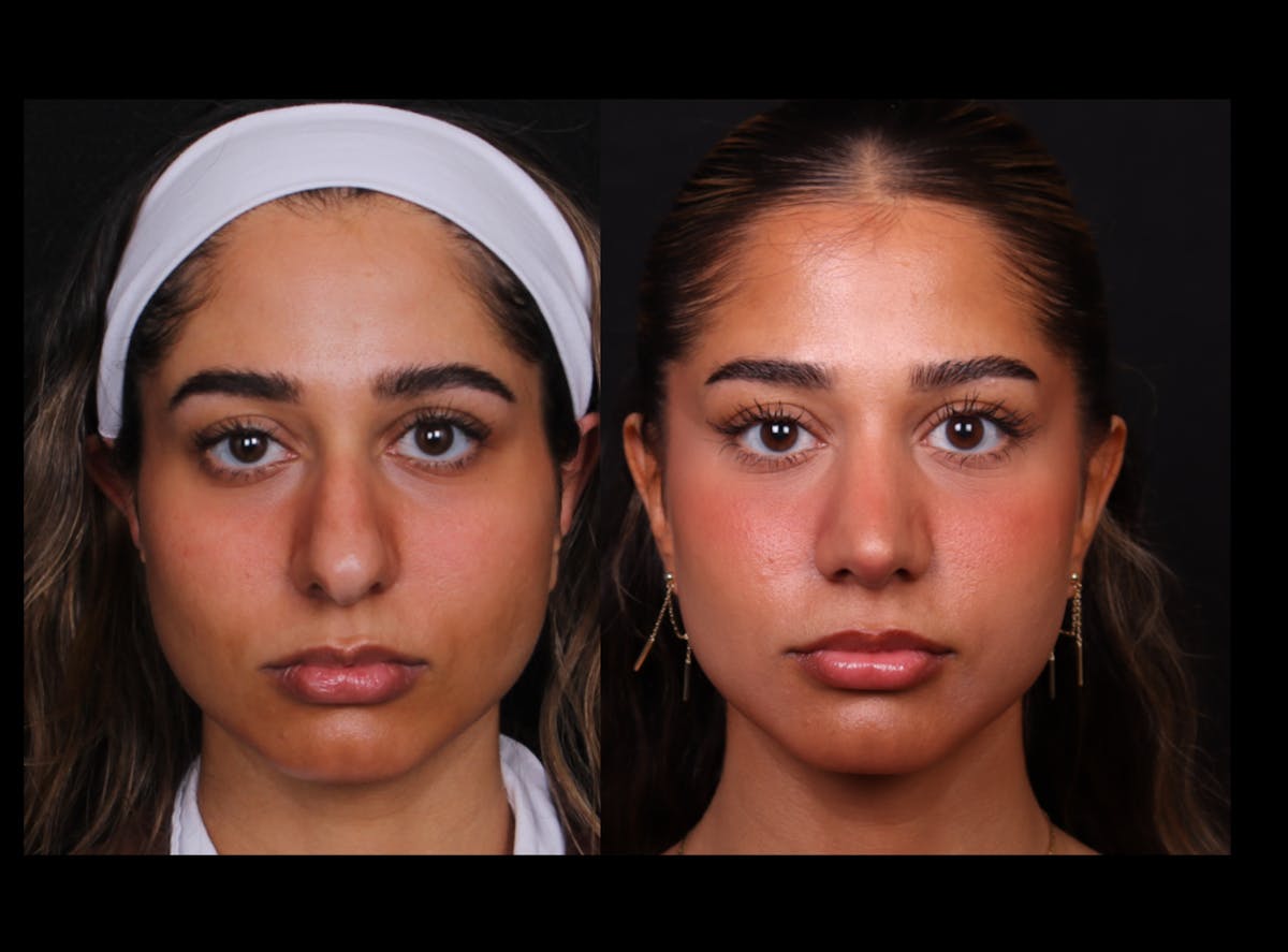 Rhinoplasty Female Before & After Gallery - Patient 329804 - Image 5