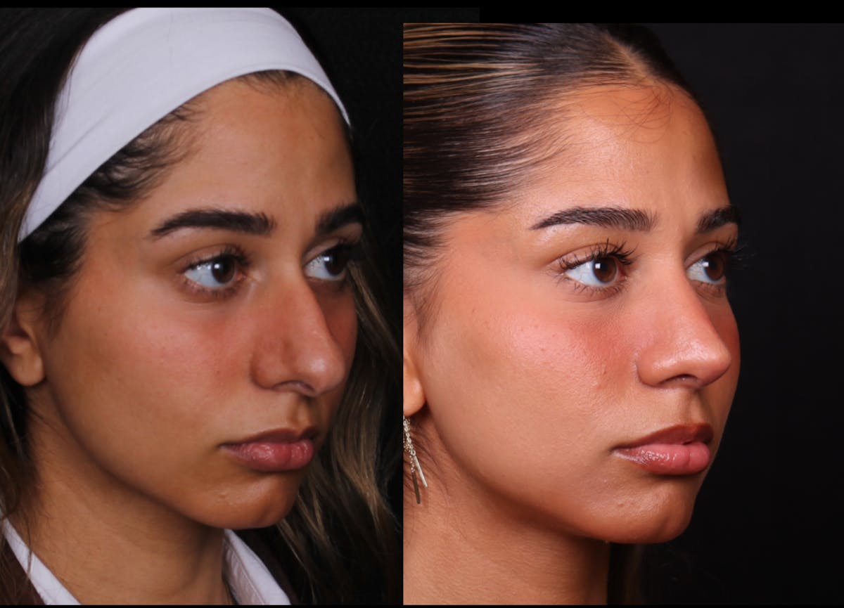 Rhinoplasty Female Before & After Gallery - Patient 329804 - Image 2