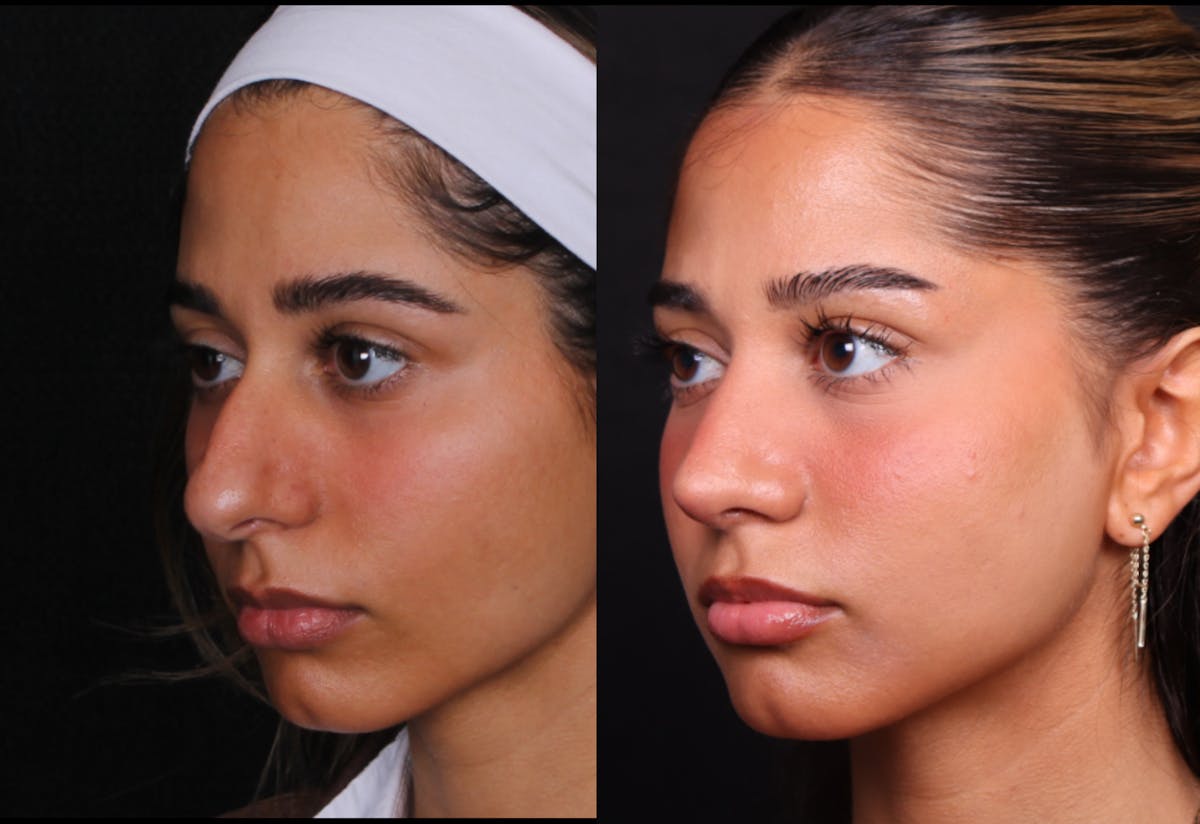 Rhinoplasty Female Before & After Gallery - Patient 329804 - Image 7