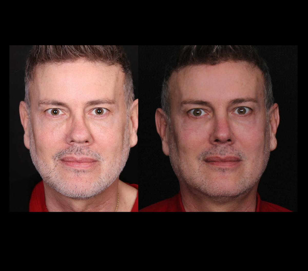 Rhinoplasty Male Before & After Gallery - Patient 389848 - Image 3
