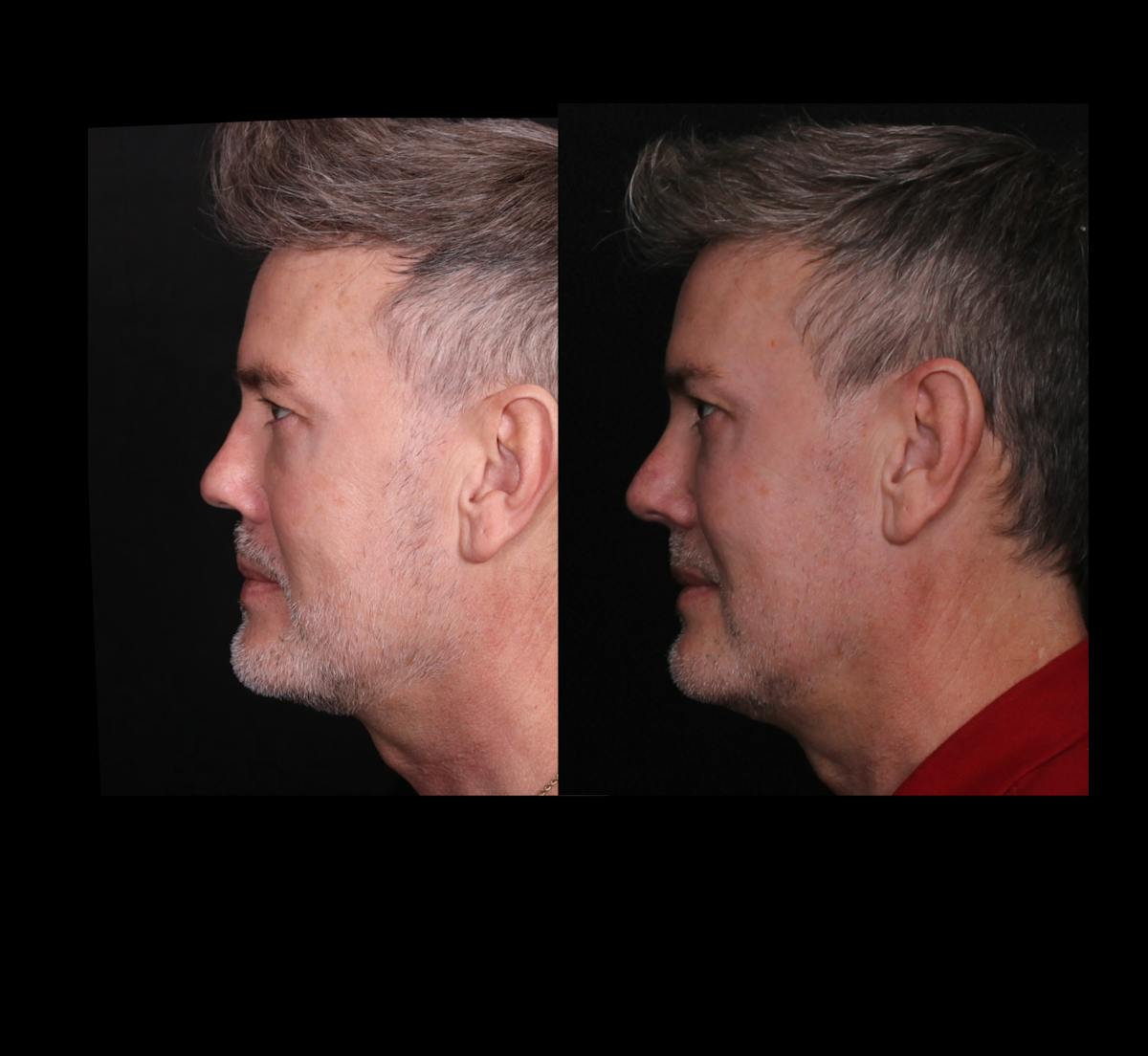 Rhinoplasty Male Before & After Gallery - Patient 389848 - Image 7