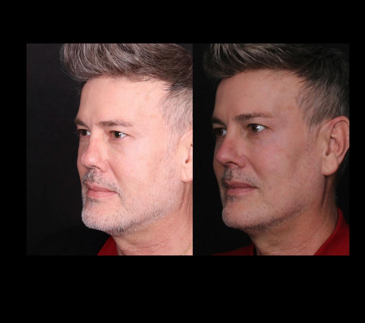 Rhinoplasty Male Before & After Gallery - Patient 389848 - Image 6
