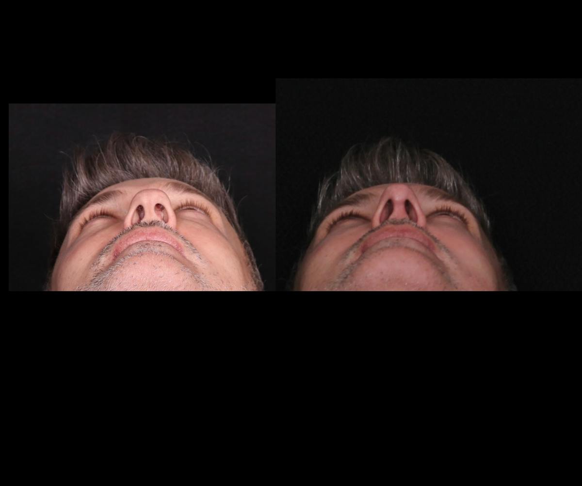 Rhinoplasty Male Before & After Gallery - Patient 389848 - Image 5
