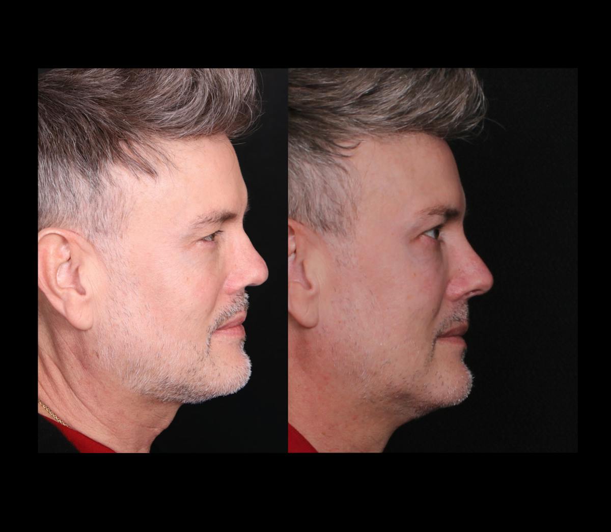Rhinoplasty Male Before & After Gallery - Patient 389848 - Image 1