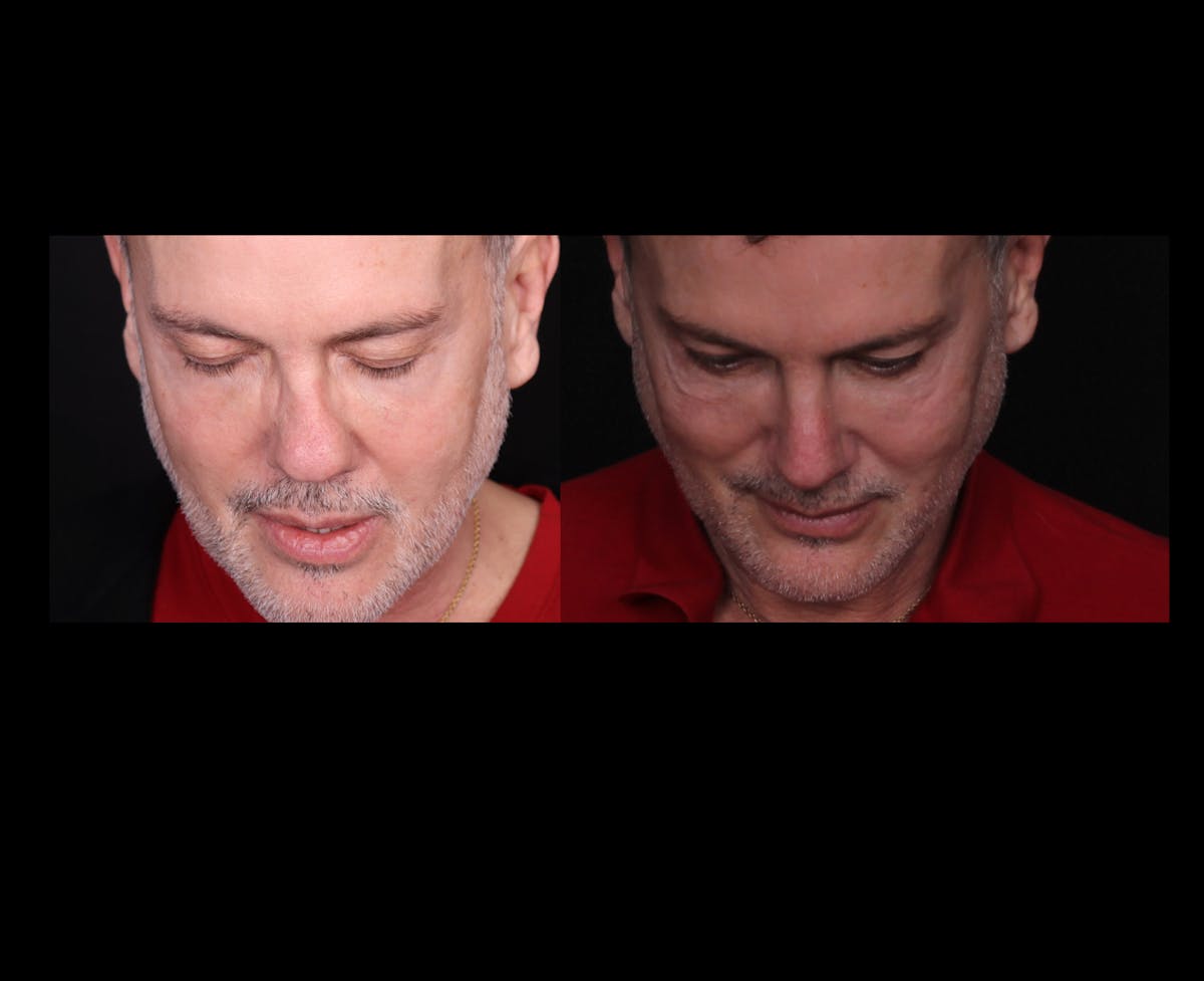 Rhinoplasty Male Before & After Gallery - Patient 389848 - Image 4