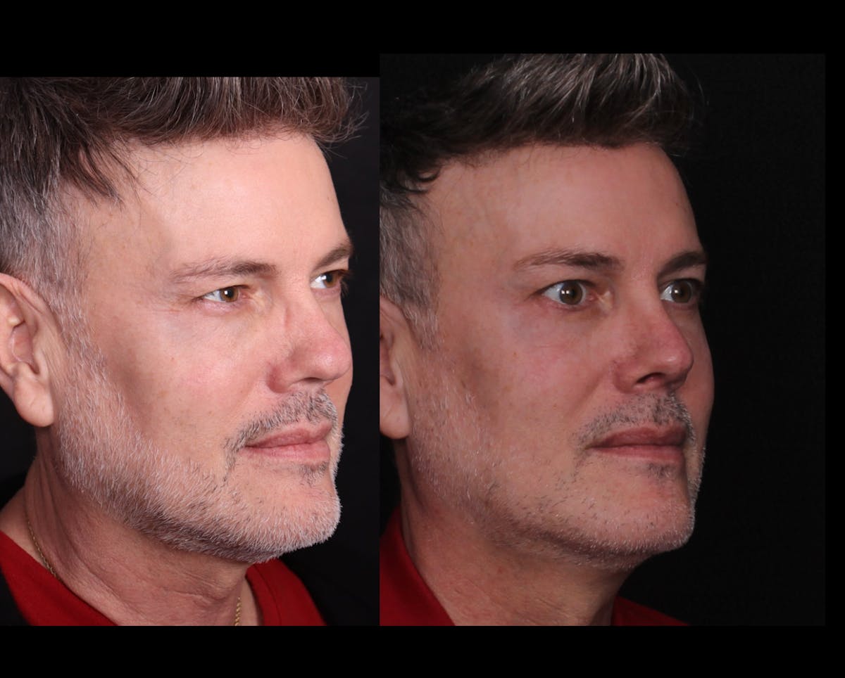 Rhinoplasty Male Before & After Gallery - Patient 389848 - Image 2
