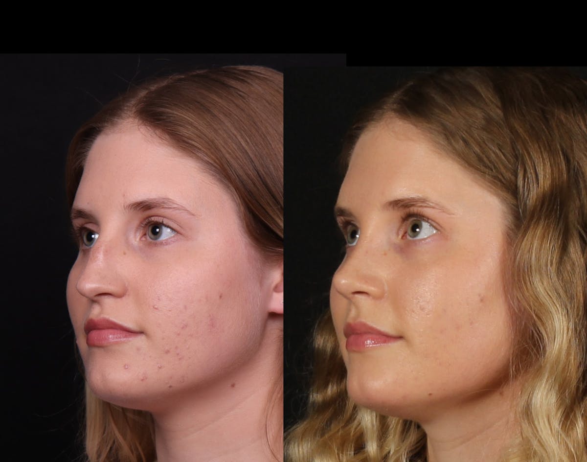 Rhinoplasty Female Before & After Gallery - Patient 396382 - Image 6