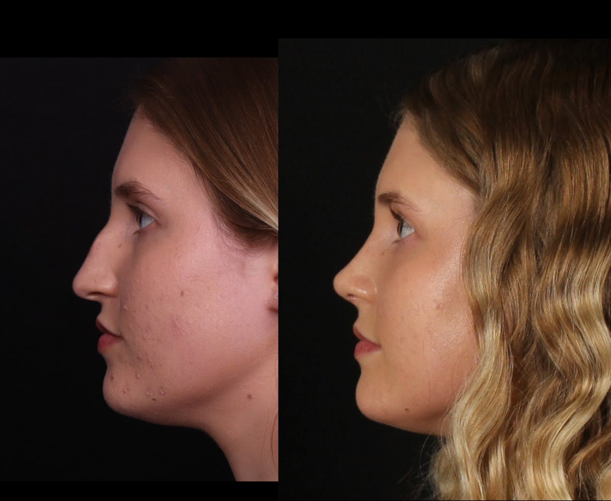 Rhinoplasty Female Before & After Gallery - Patient 396382 - Image 7