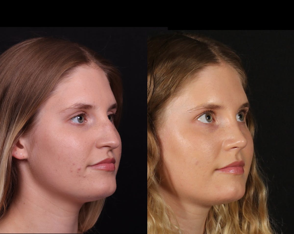 Rhinoplasty Female Before & After Gallery - Patient 396382 - Image 2