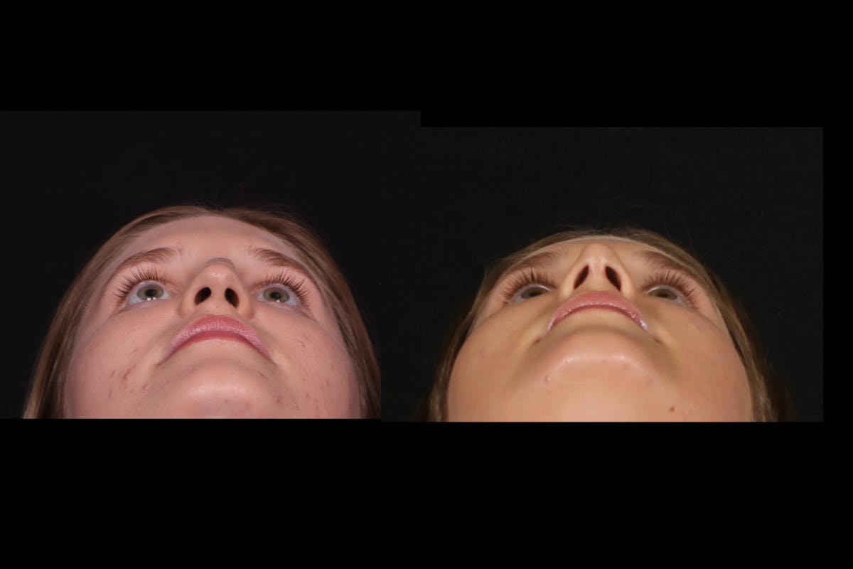 Rhinoplasty Female Before & After Gallery - Patient 396382 - Image 5