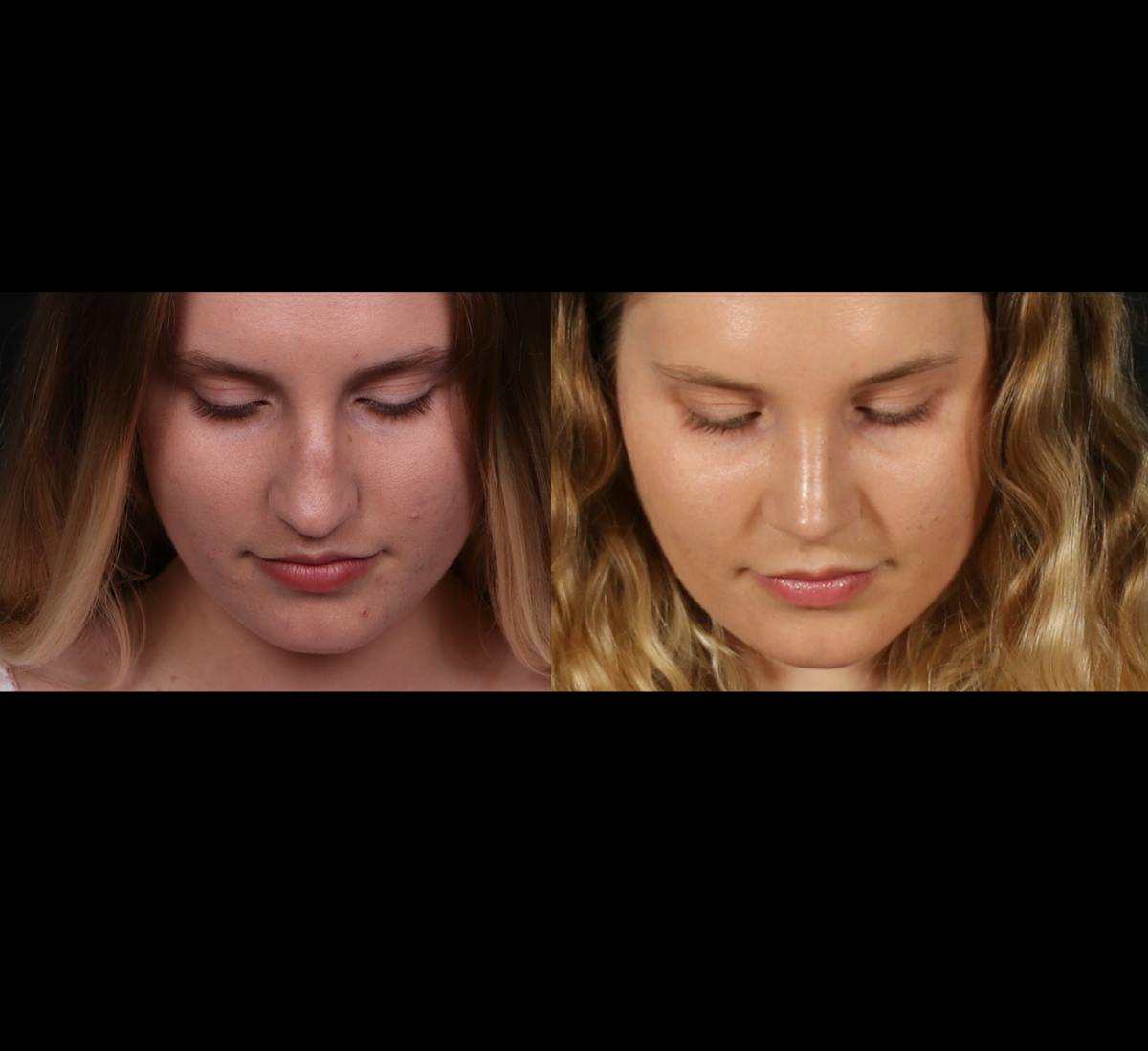 Rhinoplasty Female Before & After Gallery - Patient 396382 - Image 4