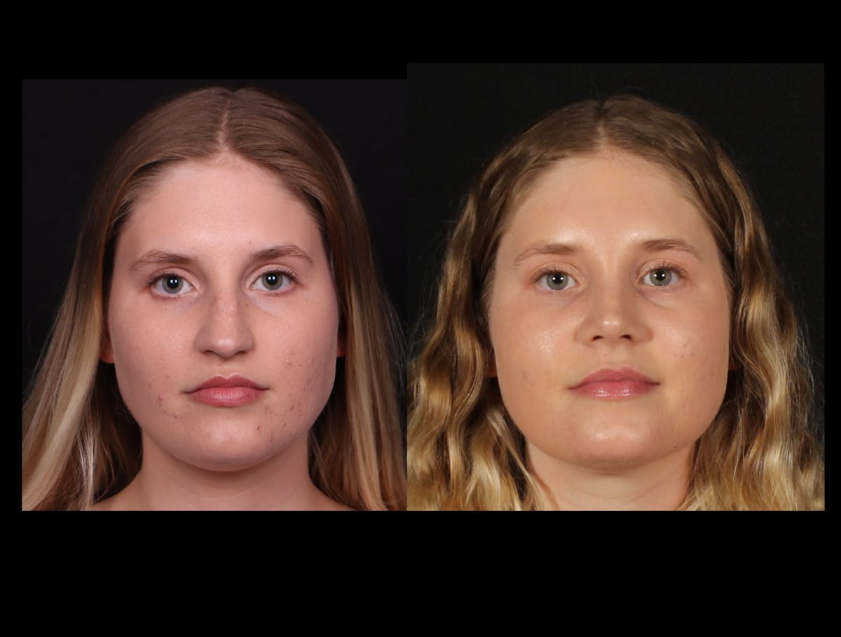 Rhinoplasty Female Before & After Gallery - Patient 396382 - Image 3