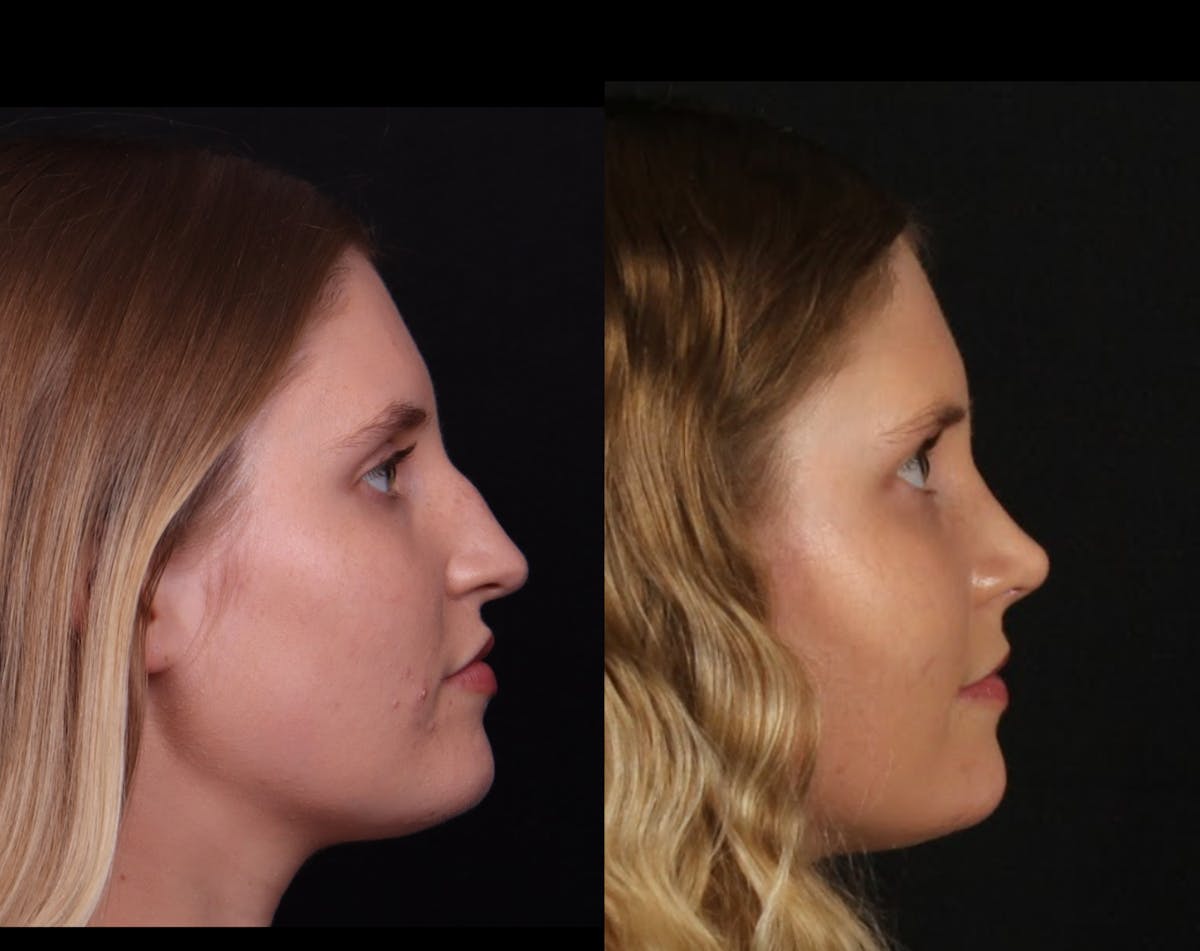 Rhinoplasty Female Before & After Gallery - Patient 396382 - Image 1