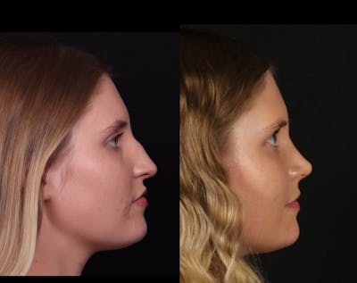 Rhinoplasty Female Before & After Gallery - Patient 396382 - Image 1