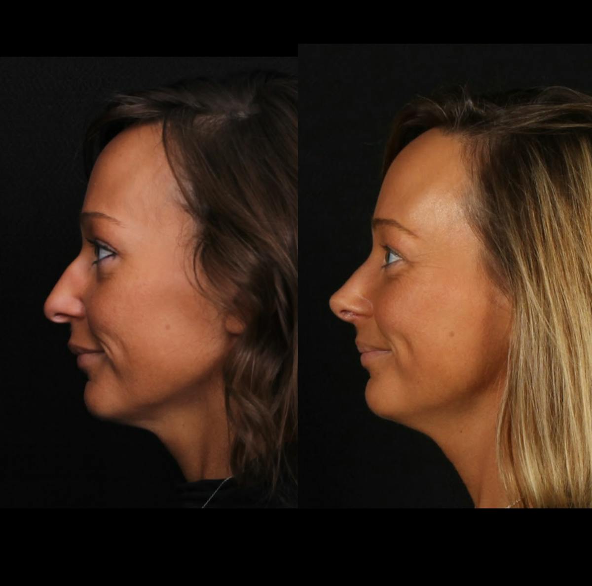 Rhinoplasty Female Before & After Gallery - Patient 624732 - Image 5