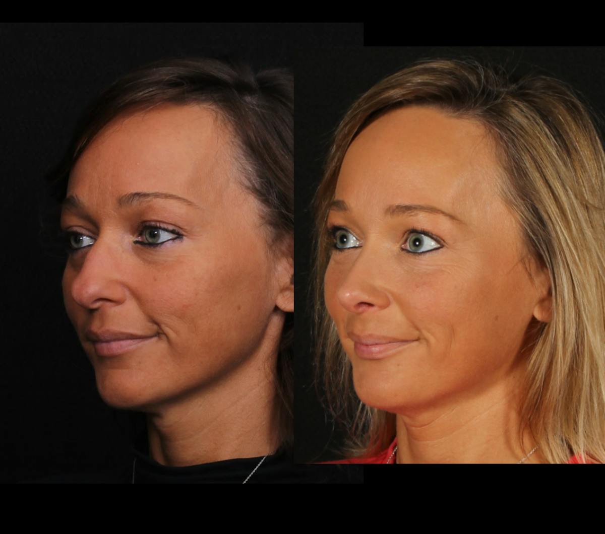 Rhinoplasty Female Before & After Gallery - Patient 624732 - Image 4