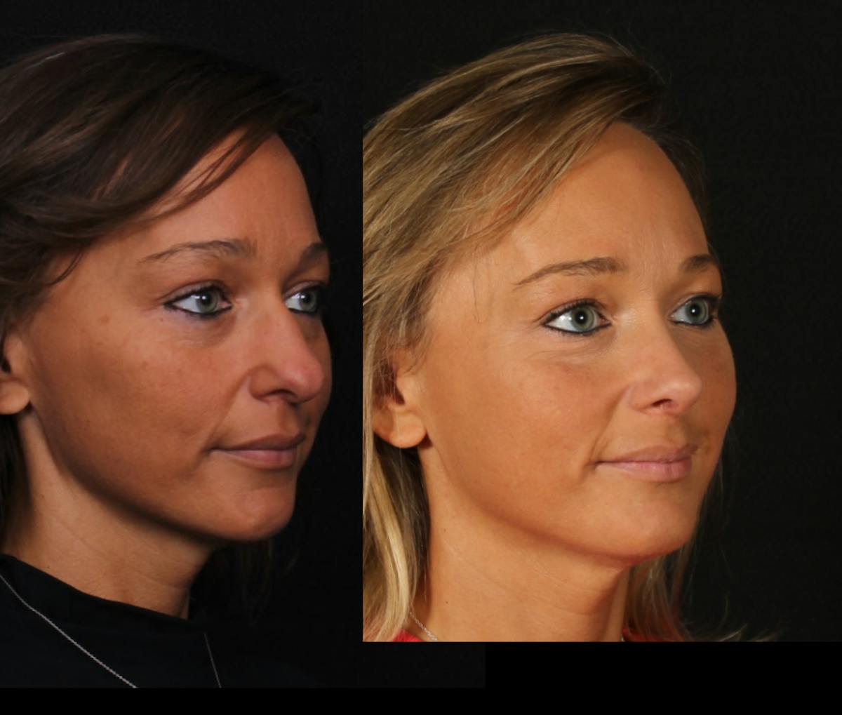 Rhinoplasty Female Before & After Gallery - Patient 624732 - Image 2